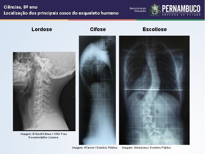 Ciências, 8º ano Localização dos principais ossos do esqueleto humano Lordose Cifose Escoliose Imagem: