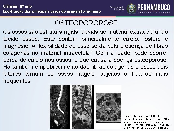 Ciências, 8º ano Localização dos principais ossos do esqueleto humano OSTEOPOROROSE Os ossos são