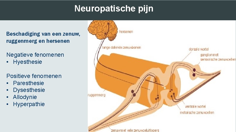 Neuropatische pijn Beschadiging van een zenuw, ruggenmerg en hersenen Negatieve fenomenen • Hyesthesie Positieve