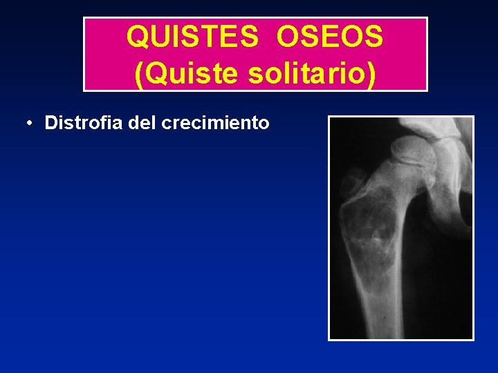 QUISTES OSEOS (Quiste solitario) • Distrofia del crecimiento 