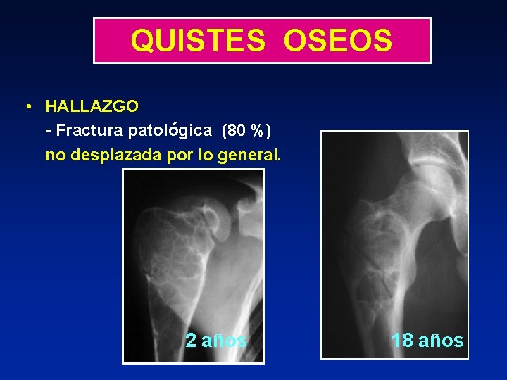 QUISTES OSEOS • HALLAZGO - Fractura patológica (80 %) no desplazada por lo general.