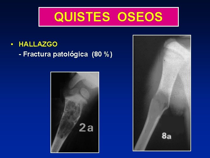 QUISTES OSEOS • HALLAZGO - Fractura patológica (80 %) 