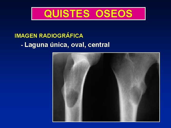 QUISTES OSEOS IMAGEN RADIOGRÁFICA - Laguna única, oval, central 