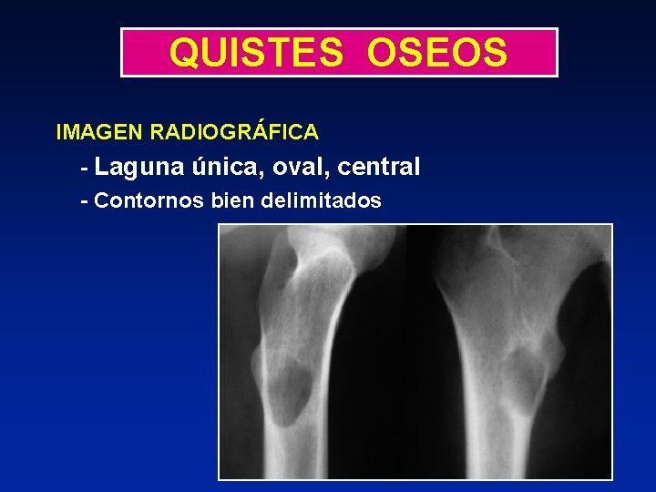 QUISTES OSEOS IMAGEN RADIOGRÁFICA - Laguna única, oval, central - Contornos bien delimitados 