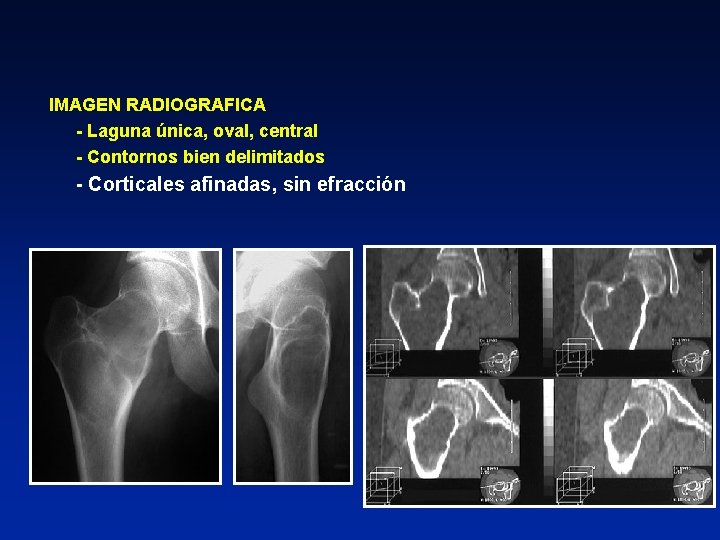 IMAGEN RADIOGRAFICA - Laguna única, oval, central - Contornos bien delimitados - Corticales afinadas,