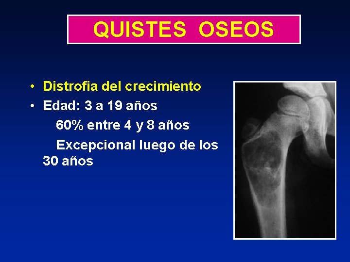 QUISTES OSEOS • Distrofia del crecimiento • Edad: 3 a 19 años 60% entre