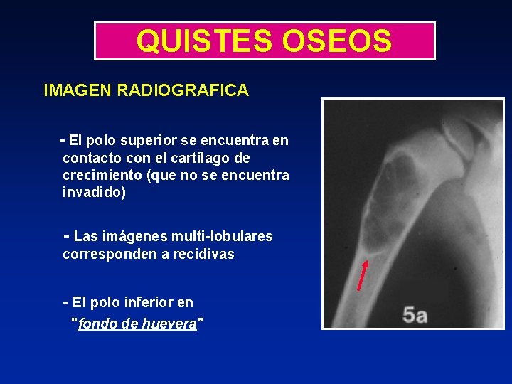 QUISTES OSEOS IMAGEN RADIOGRAFICA - El polo superior se encuentra en contacto con el