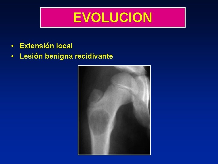 EVOLUCION • Extensión local • Lesión benigna recidivante 