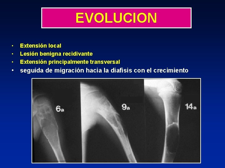 EVOLUCION • • • Extensión local Lesión benigna recidivante Extensión principalmente transversal • seguida