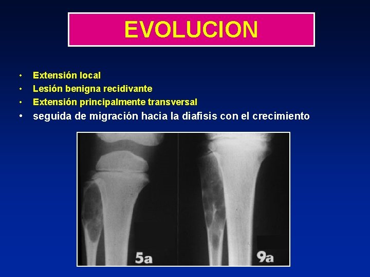 EVOLUCION • • • Extensión local Lesión benigna recidivante Extensión principalmente transversal • seguida