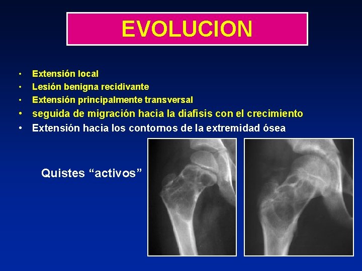 EVOLUCION • • • Extensión local Lesión benigna recidivante Extensión principalmente transversal • seguida