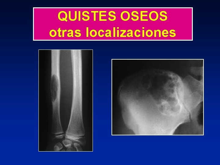 QUISTES OSEOS otras localizaciones 