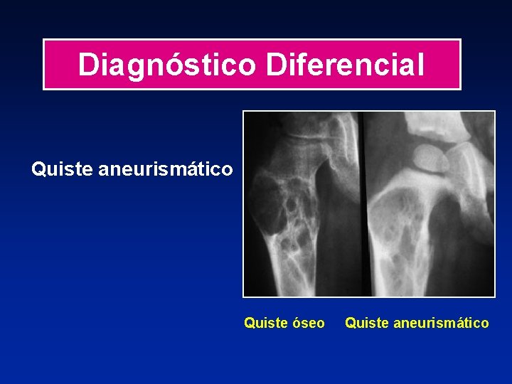 Diagnóstico Diferencial Quiste aneurismático Quiste óseo Quiste aneurismático 