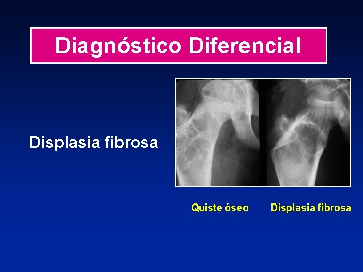 Diagnóstico Diferencial Displasia fibrosa Quiste óseo Displasia fibrosa 