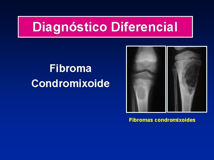 Diagnóstico Diferencial Fibroma Condromixoide Fibromas condromixoides 
