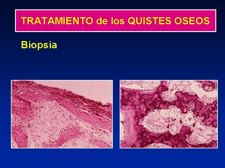 TRATAMIENTO de los QUISTES OSEOS Biopsia 