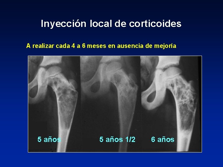 Inyección local de corticoides A realizar cada 4 a 6 meses en ausencia de