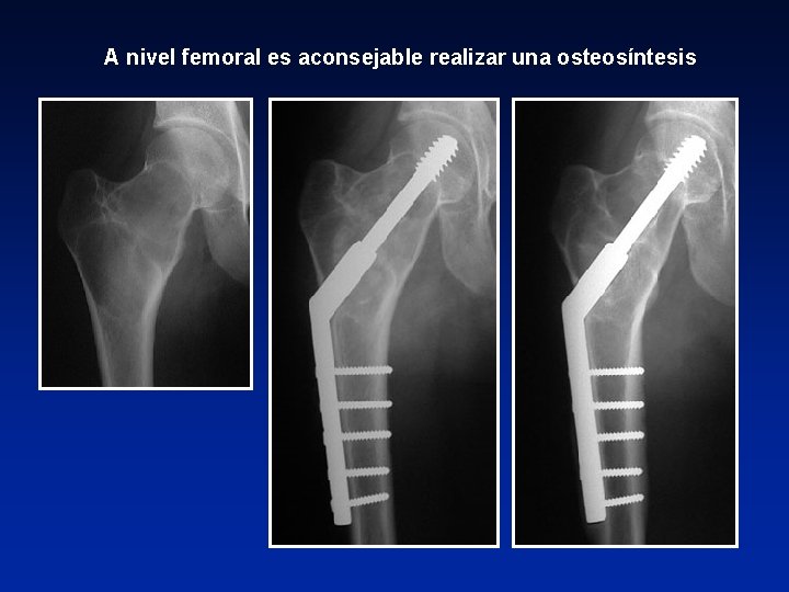 A nivel femoral es aconsejable realizar una osteosíntesis 