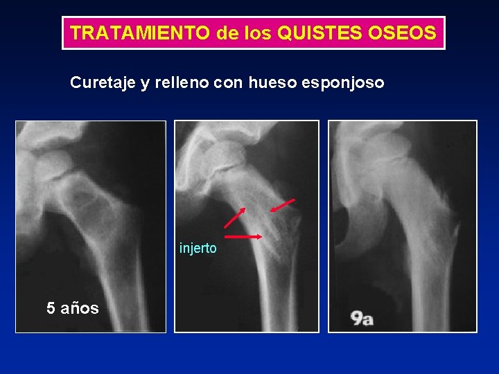 TRATAMIENTO de los QUISTES OSEOS Curetaje y relleno con hueso esponjoso injerto 5 años