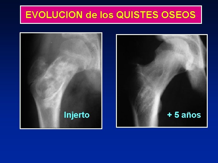 EVOLUCION de los QUISTES OSEOS Injerto + 5 años 