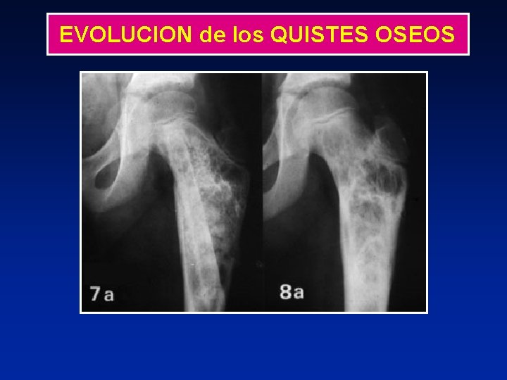 EVOLUCION de los QUISTES OSEOS 