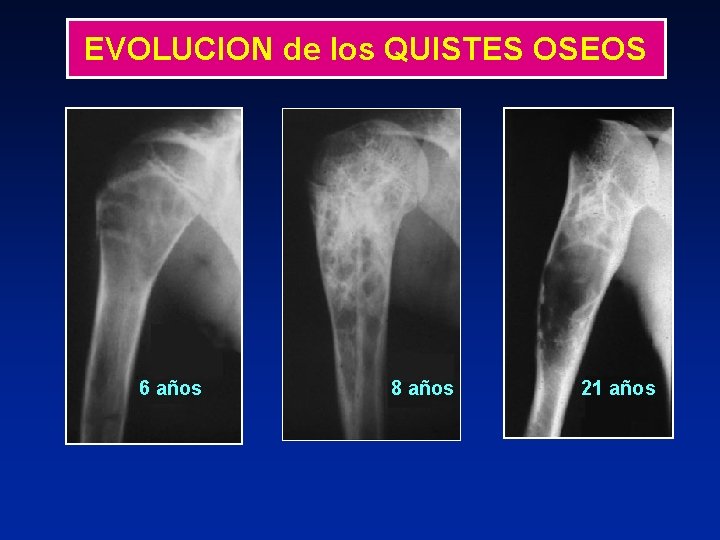 EVOLUCION de los QUISTES OSEOS 6 años 8 años 21 años 