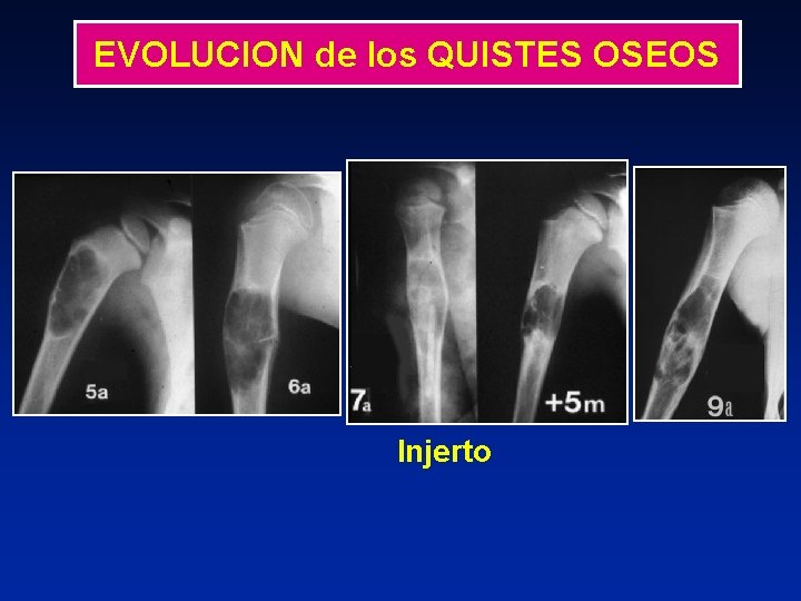 EVOLUCION de los QUISTES OSEOS Injerto 