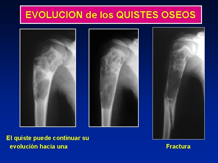 EVOLUCION de los QUISTES OSEOS ÉVOLUTION Kyste restant actif avec aggravation de l’image préexistante