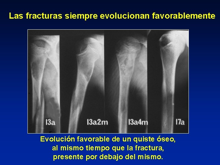 Las fracturas siempre evolucionan favorablemente Evolución favorable de un quiste óseo, al mismo tiempo