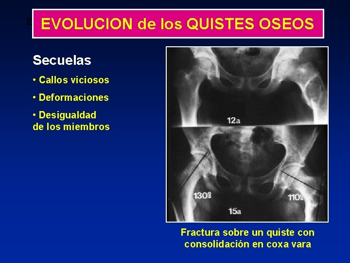 EVOLUCION de los QUISTES OSEOS ÉVOLUTION Kyste restant actif avec aggravation de l’image préexistante