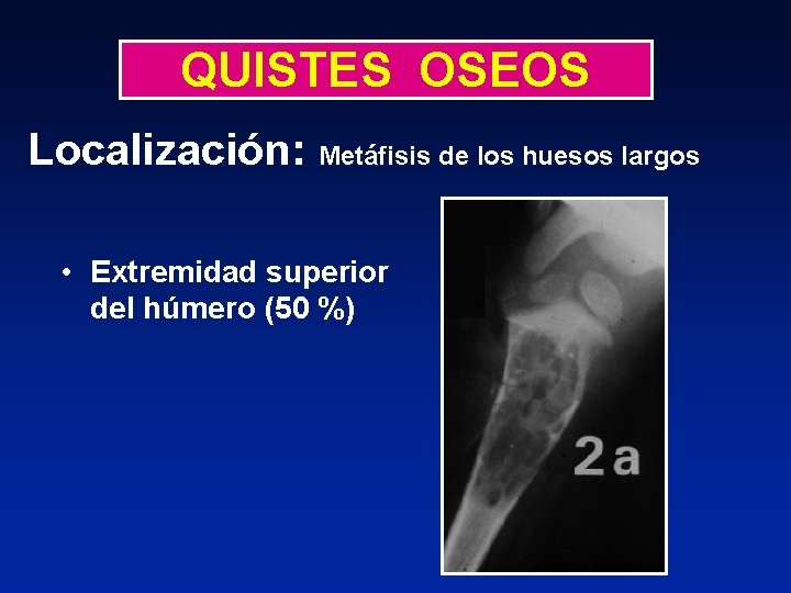 QUISTES OSEOS Localización: Metáfisis de los huesos largos • Extremidad superior del húmero (50