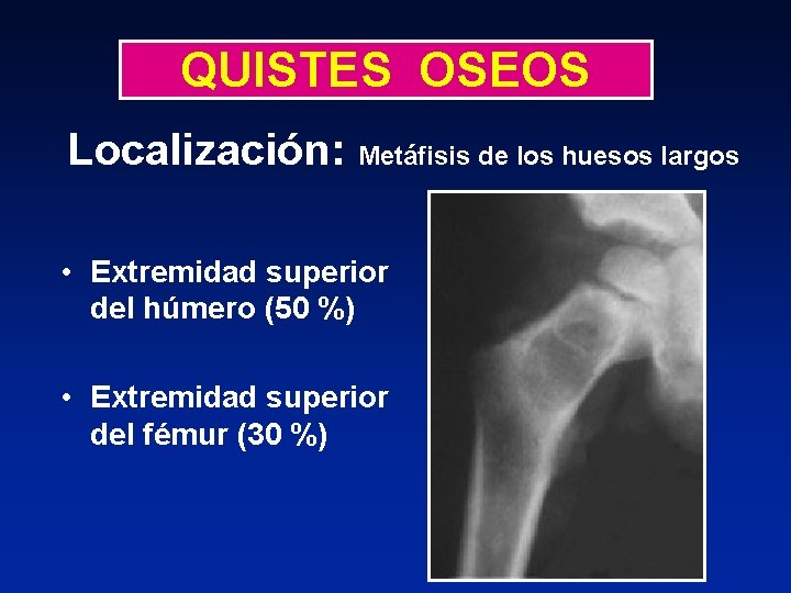 QUISTES OSEOS Localización: Metáfisis de los huesos largos • Extremidad superior del húmero (50