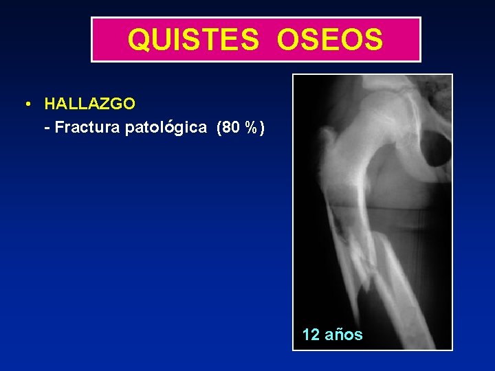 QUISTES OSEOS • HALLAZGO - Fractura patológica (80 %) 12 años 