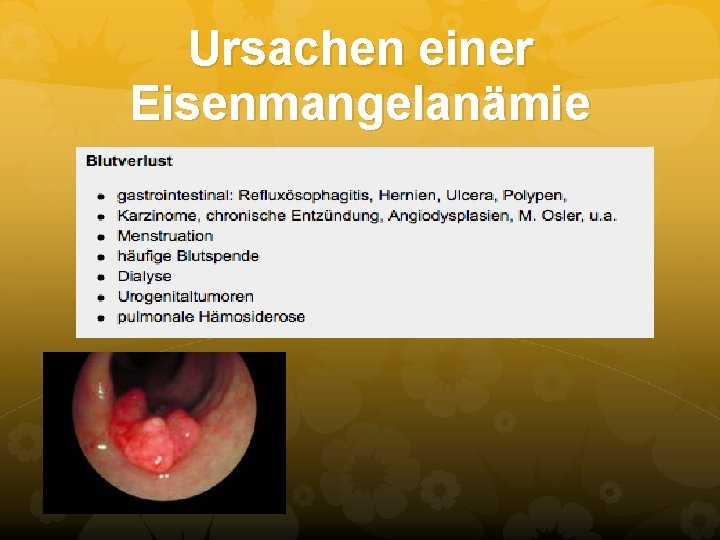 Ursachen einer Eisenmangelanämie Ursachen einer Eisenmangelanämie