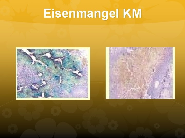 Eisenmangel KM Eisenmangel KM