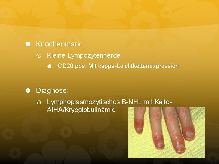 Knochenmark: Kleine Lympozytenherde CD 20 pos. Mit kappa-Leichtkettenexpression Diagnose: Lymphoplasmozytisches B-NHL mit Kälte- Knochenmark: Kleine Lympozytenherde CD 20 pos. Mit kappa-Leichtkettenexpression Diagnose: Lymphoplasmozytisches B-NHL mit Kälte-