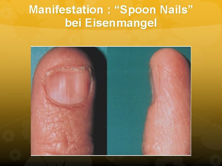 Manifestation : “Spoon Nails” bei Eisenmangel Manifestation : “Spoon Nails” bei Eisenmangel
