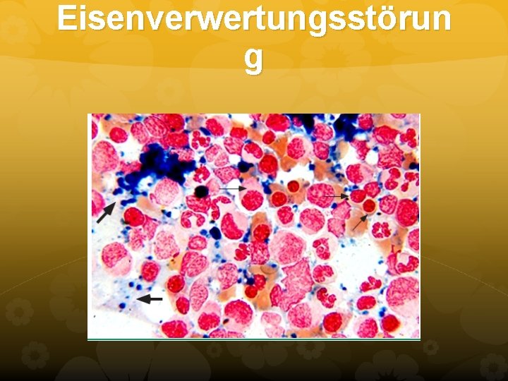 Eisenverwertungsstörun g Eisenverwertungsstörun g