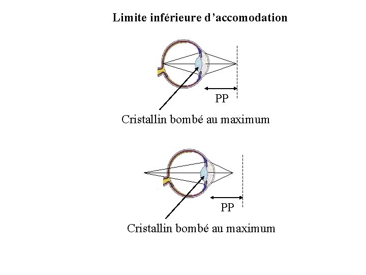 Limite inférieure d’accomodation PP Cristallin bombé au maximum 