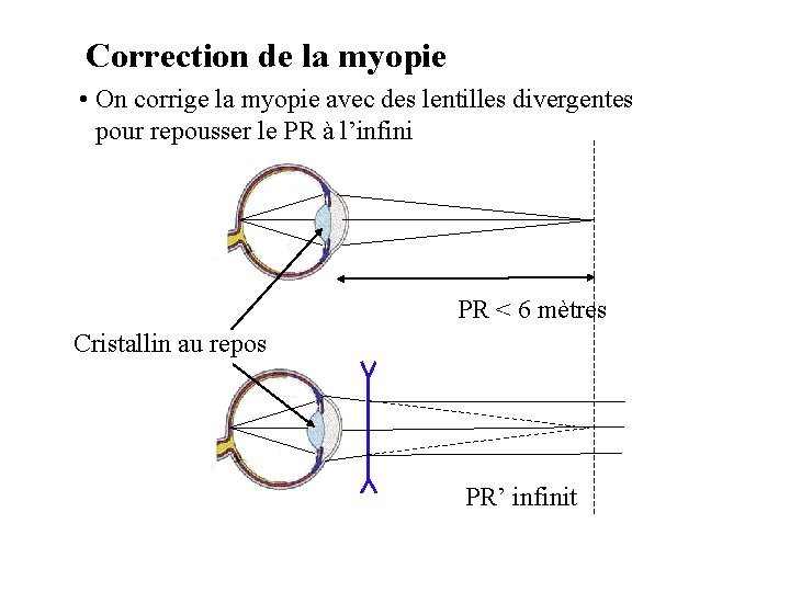 Correction de la myopie • On corrige la myopie avec des lentilles divergentes pour