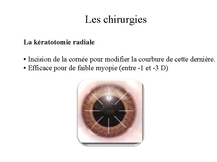 Les chirurgies La kératotomie radiale • Incision de la cornée pour modifier la courbure