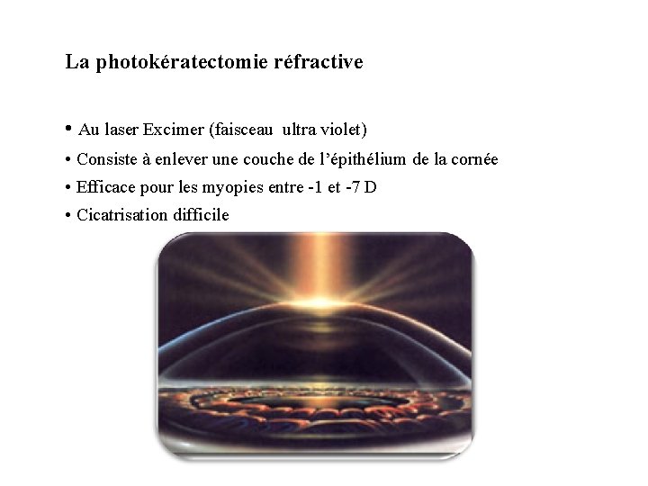 La photokératectomie réfractive • Au laser Excimer (faisceau ultra violet) • Consiste à enlever