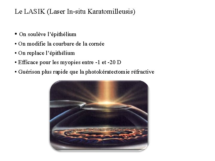 Le LASIK (Laser In-situ Karatomilleusis) • On soulève l’épithélium • On modifie la courbure