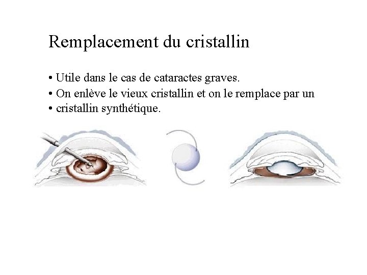 Remplacement du cristallin • Utile dans le cas de cataractes graves. • On enlève
