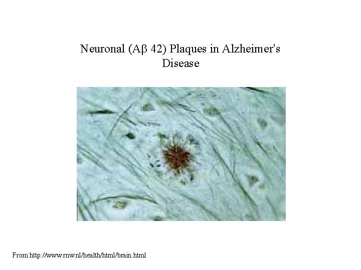 Neuronal (Ab 42) Plaques in Alzheimer’s Disease From http: //www. rnw. nl/health/html/brain. html Neuronal (Ab 42) Plaques in Alzheimer’s Disease From http: //www. rnw. nl/health/html/brain. html