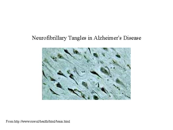 Neurofibrillary Tangles in Alzheimer’s Disease From http: //www. rnw. nl/health/html/brain. html Neurofibrillary Tangles in Alzheimer’s Disease From http: //www. rnw. nl/health/html/brain. html