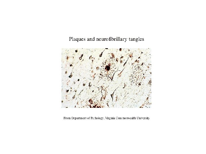 Plaques and neurofibrillary tangles From Department of Pathology, Virginia Commonwealth University Plaques and neurofibrillary tangles From Department of Pathology, Virginia Commonwealth University