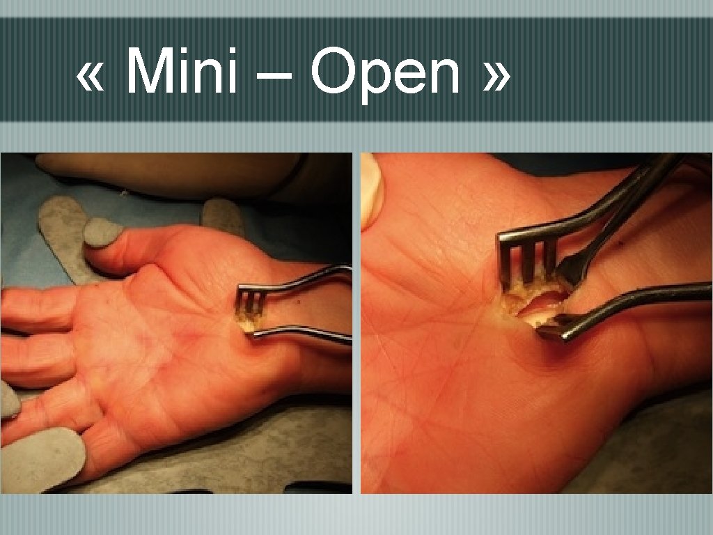  « Mini – Open » 
