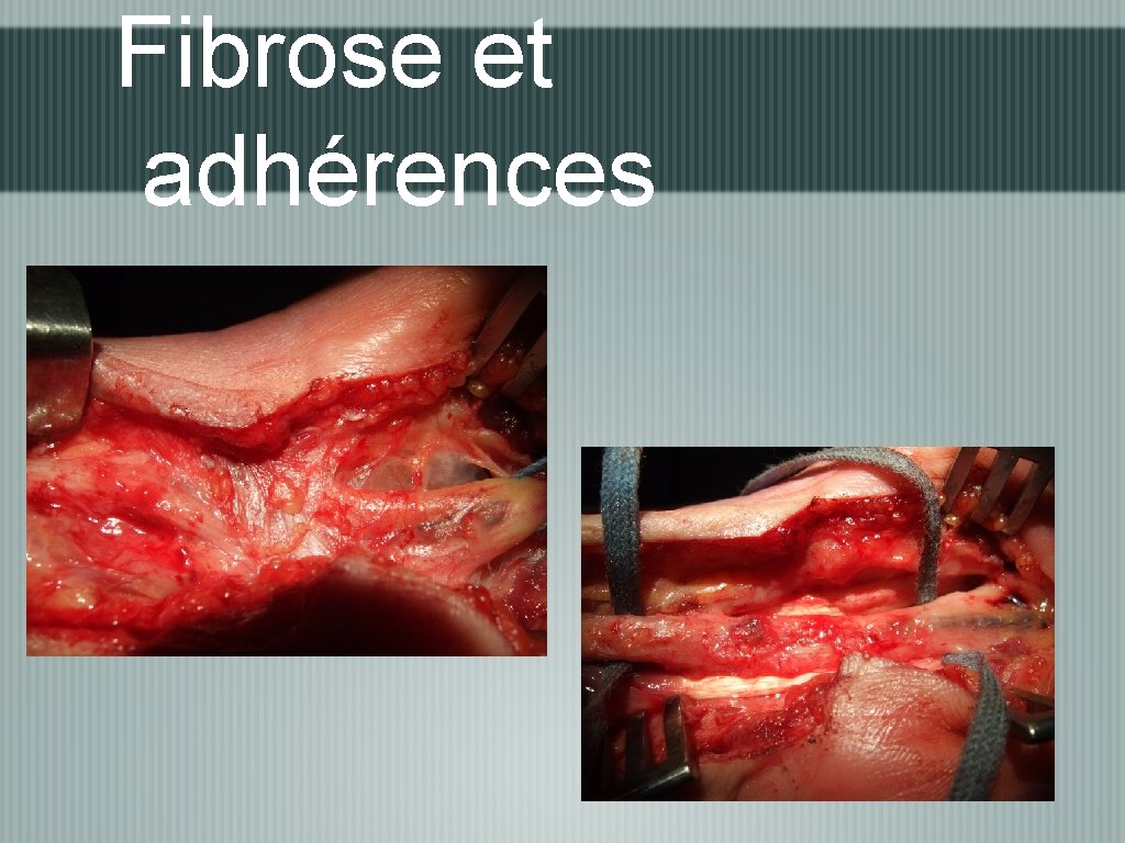 Fibrose et adhérences 