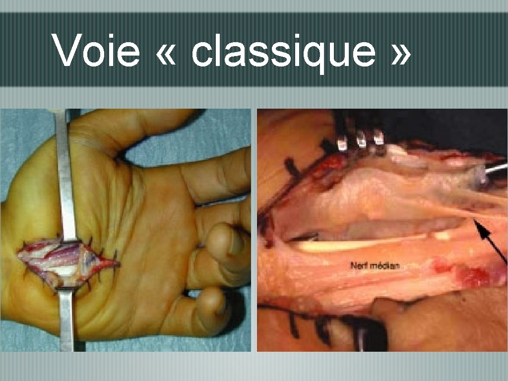 Voie « classique » 